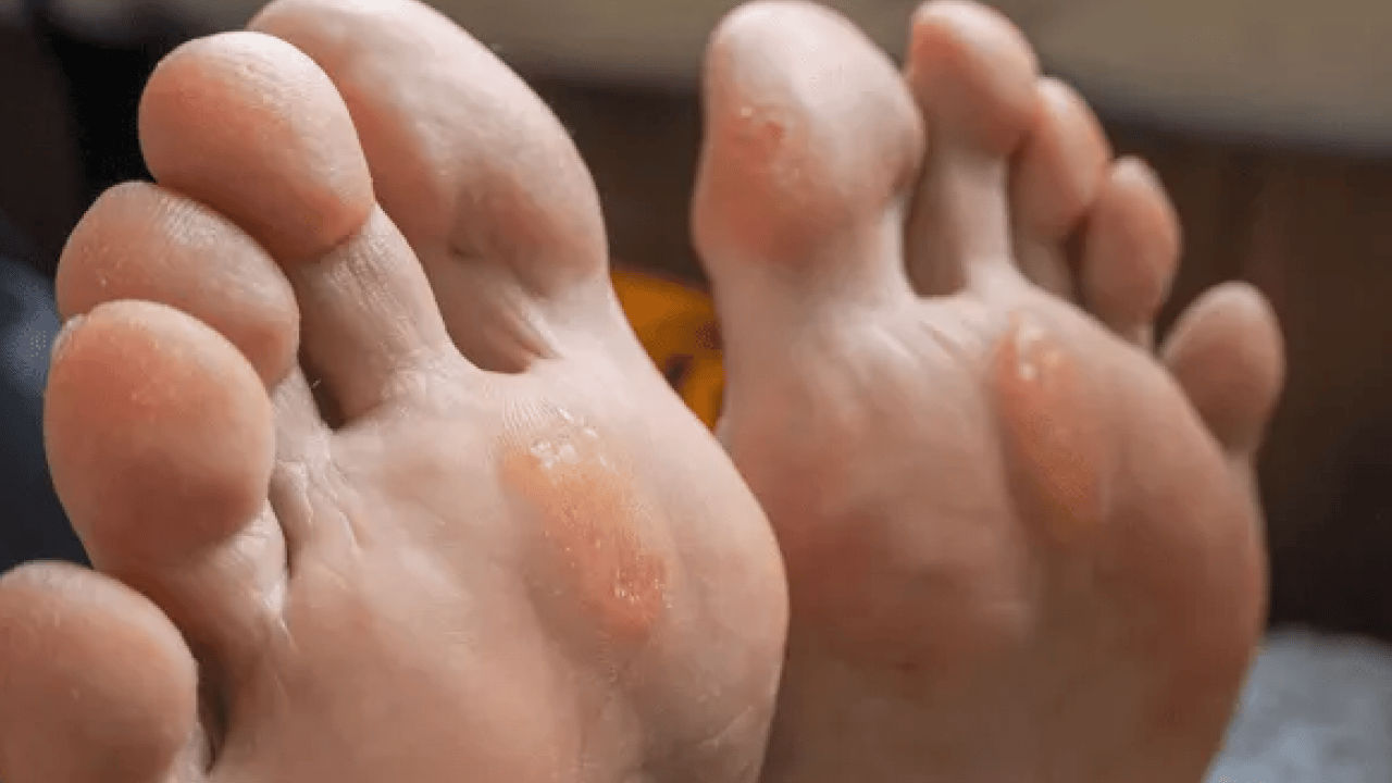 Ayak nasırlarına bitkisel çözümler: Nasırı kökünden söküp atıyor! Söküp atmanın doğal yolu