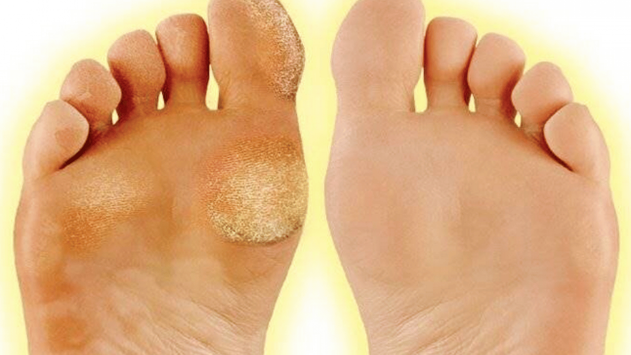 Foto - Ayak nasırlarına bitkisel çözümler: Nasırı kökünden söküp atıyor! Söküp atmanın doğal yolu