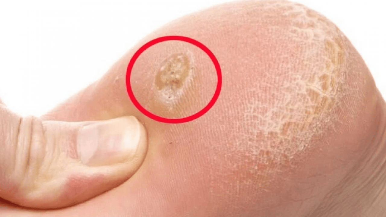 Foto - Ayak nasırlarına bitkisel çözümler: Nasırı kökünden söküp atıyor! Söküp atmanın doğal yolu