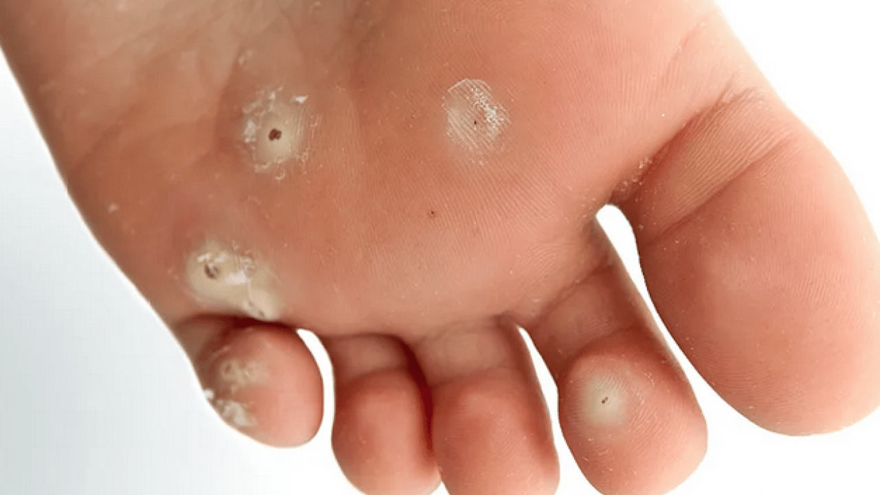 Foto - Ayak nasırlarına bitkisel çözümler: Nasırı kökünden söküp atıyor! Söküp atmanın doğal yolu