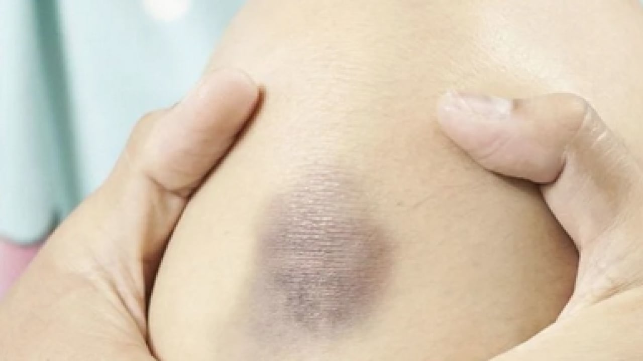 Foto - Ayaklarınız iflas etmesin aman dikkat! Hekimden lipödem işareti olabilir açıklaması...