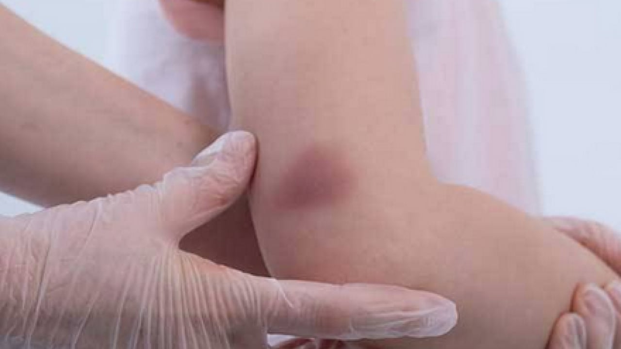 Foto - Ayaklarınız iflas etmesin aman dikkat! Hekimden lipödem işareti olabilir açıklaması...