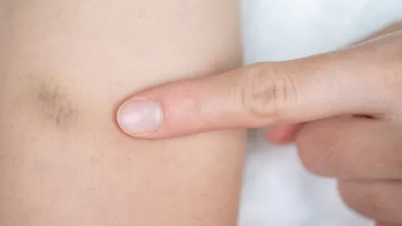 Foto - Ayaklarınız iflas etmesin aman dikkat! Hekimden lipödem işareti olabilir açıklaması...