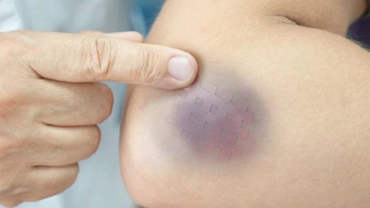 Foto - Ayaklarınız iflas etmesin aman dikkat! Hekimden lipödem işareti olabilir açıklaması...