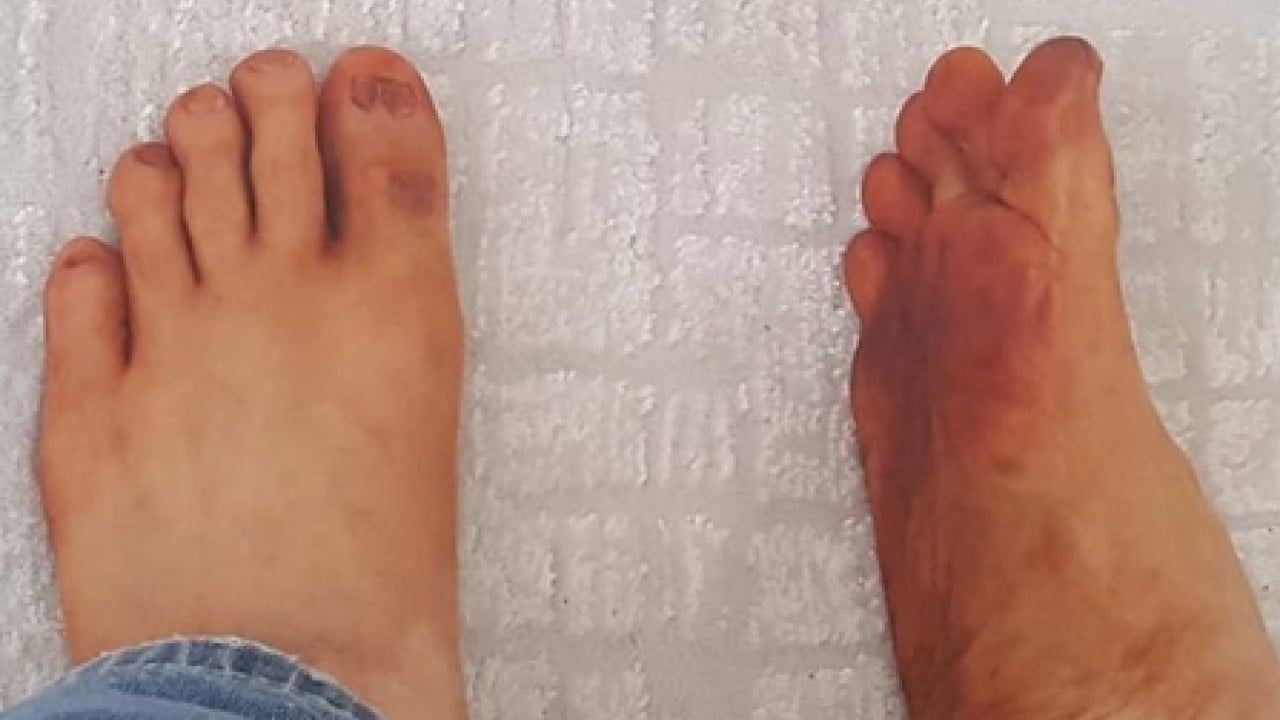 Ayakta solukluk ve iyileşmeyen yaralar: Ayak soğukluğu damar hastalığının habercisi mi?