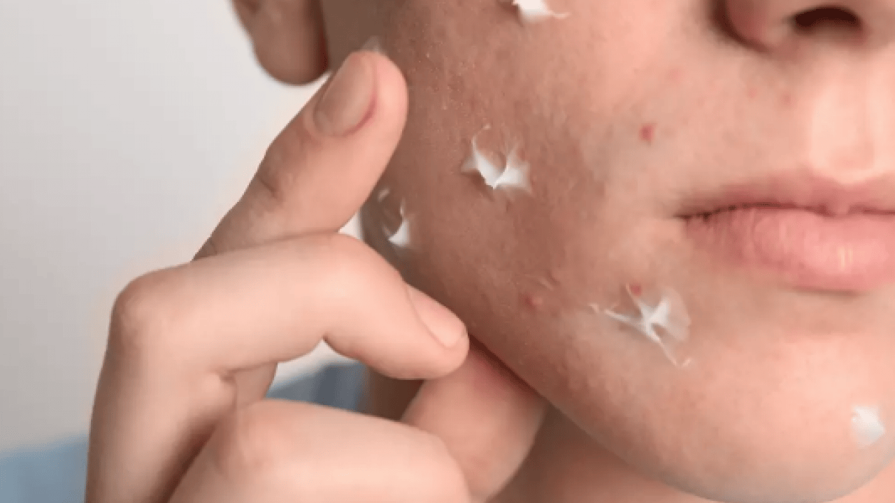 Foto - Ayrıntıya dikkat: Sivilceler neden aynı yerde çıkar? Sivilcelerin sebebi meğer buymuş