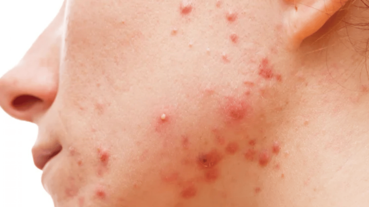 Foto - Ayrıntıya dikkat: Sivilceler neden aynı yerde çıkar? Sivilcelerin sebebi meğer buymuş