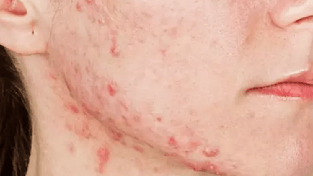 Foto - Ayrıntıya dikkat: Sivilceler neden aynı yerde çıkar? Sivilcelerin sebebi meğer buymuş