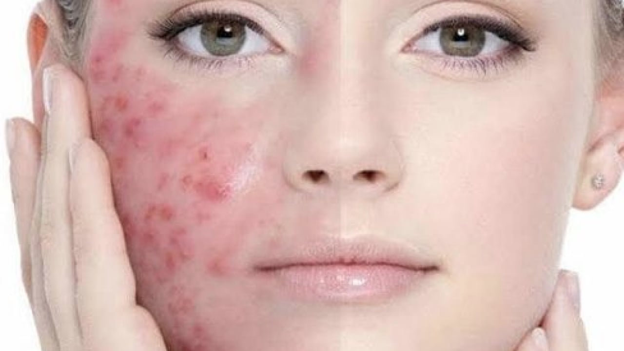 Foto - Ayrıntıya dikkat: Sivilceler neden aynı yerde çıkar? Sivilcelerin sebebi meğer buymuş