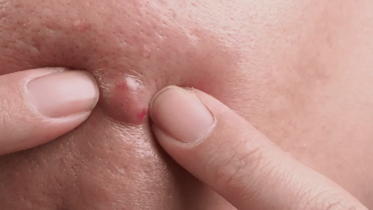 Foto - Ayrıntıya dikkat: Sivilceler neden aynı yerde çıkar? Sivilcelerin sebebi meğer buymuş