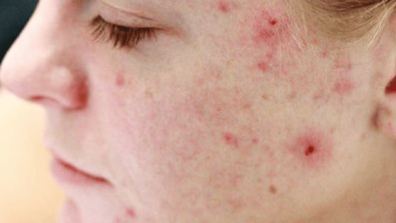 Foto - Ayrıntıya dikkat: Sivilceler neden aynı yerde çıkar? Sivilcelerin sebebi meğer buymuş