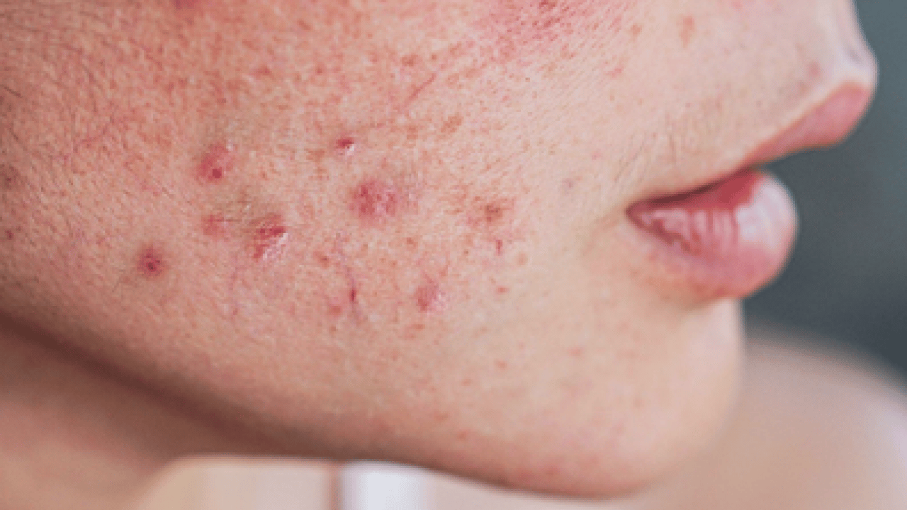 Ayrıntıya dikkat: Sivilceler neden aynı yerde çıkar? Sivilcelerin sebebi meğer buymuş