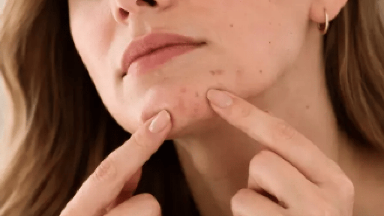 Foto - Ayrıntıya dikkat: Sivilceler neden aynı yerde çıkar? Sivilcelerin sebebi meğer buymuş