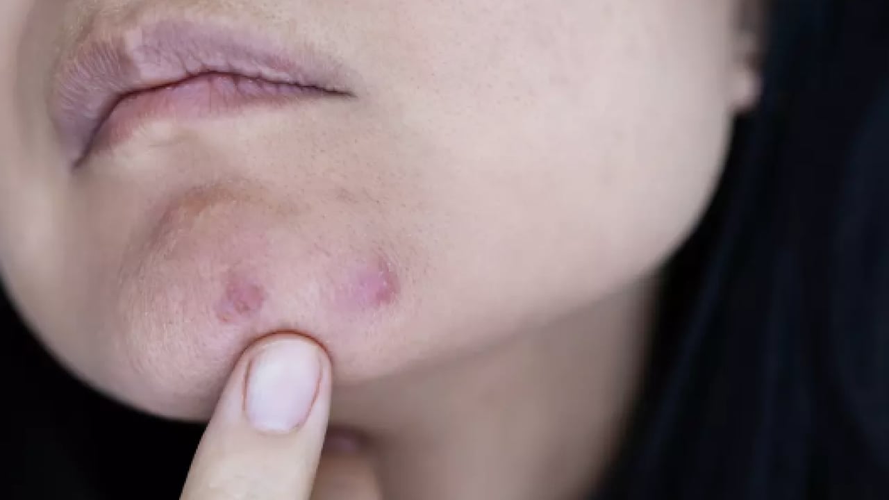 Foto - Ayrıntıya dikkat: Sivilceler neden aynı yerde çıkar? Sivilcelerin sebebi meğer buymuş