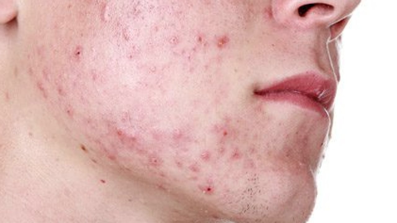 Foto - Ayrıntıya dikkat: Sivilceler neden aynı yerde çıkar? Sivilcelerin sebebi meğer buymuş