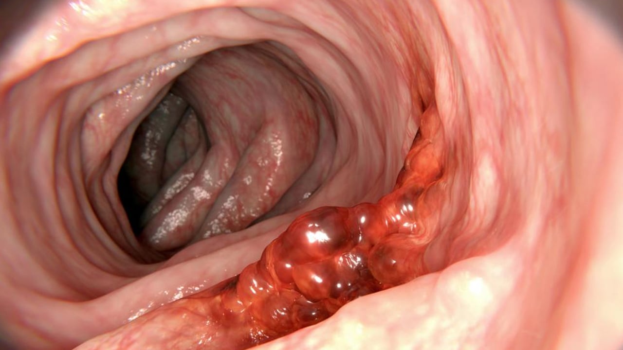 Foto - İlaç gibi geliyor! Bağırsakları, boşaltıp temizleyecek doğal karışım! 5 Mucize malzeme ile bağırsak temizliği