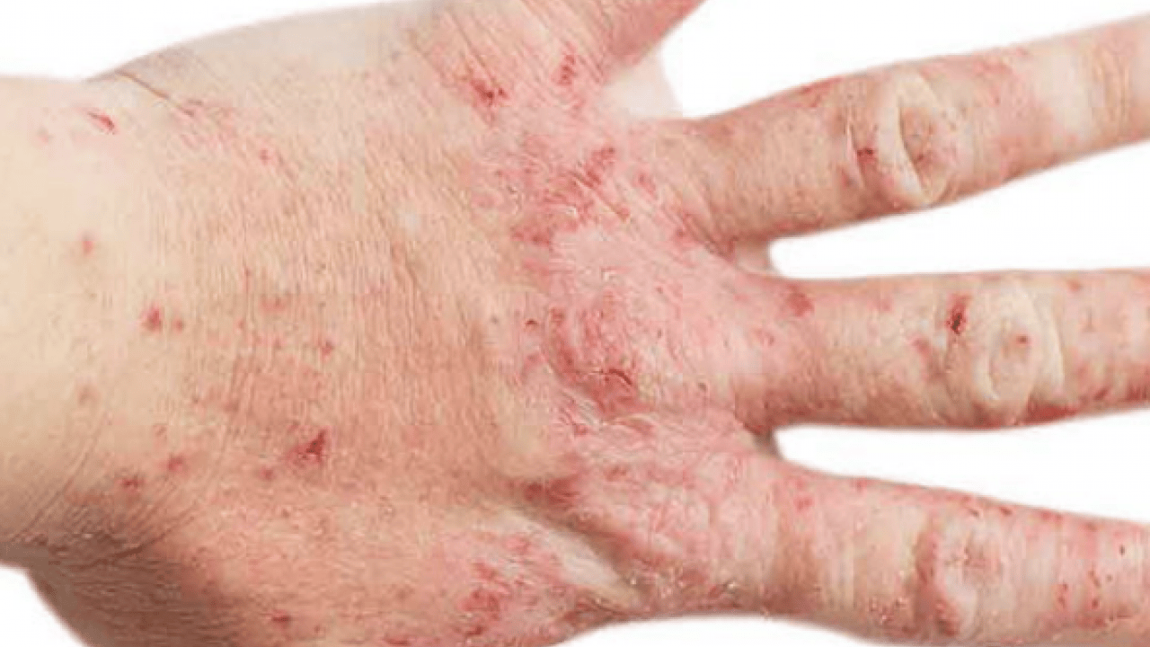 Foto - Bana uğramaz demeyin! Egzama nedir, nasıl oluşur ve nasıl geçer? Tek tek bunları not almalısınız...