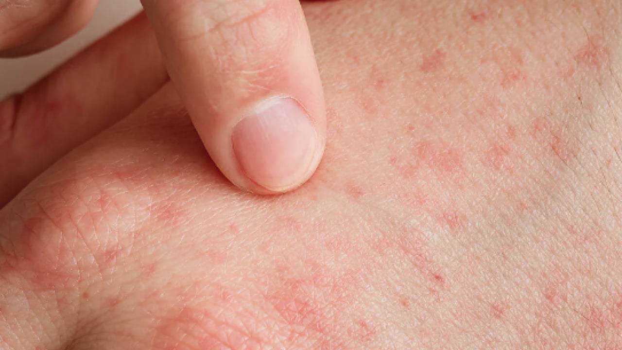 Foto - Bana uğramaz demeyin! Egzama nedir, nasıl oluşur ve nasıl geçer? Tek tek bunları not almalısınız...