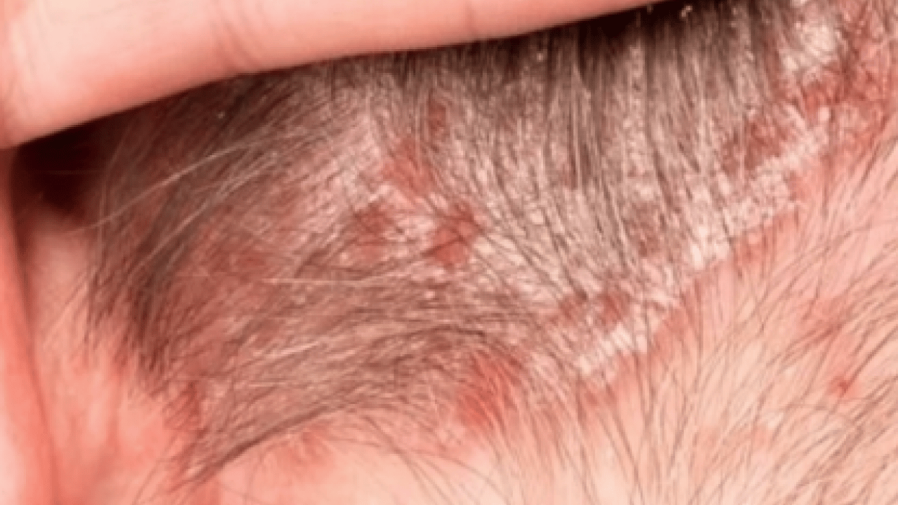 Foto - Bana uğramaz demeyin! Egzama nedir, nasıl oluşur ve nasıl geçer? Tek tek bunları not almalısınız...