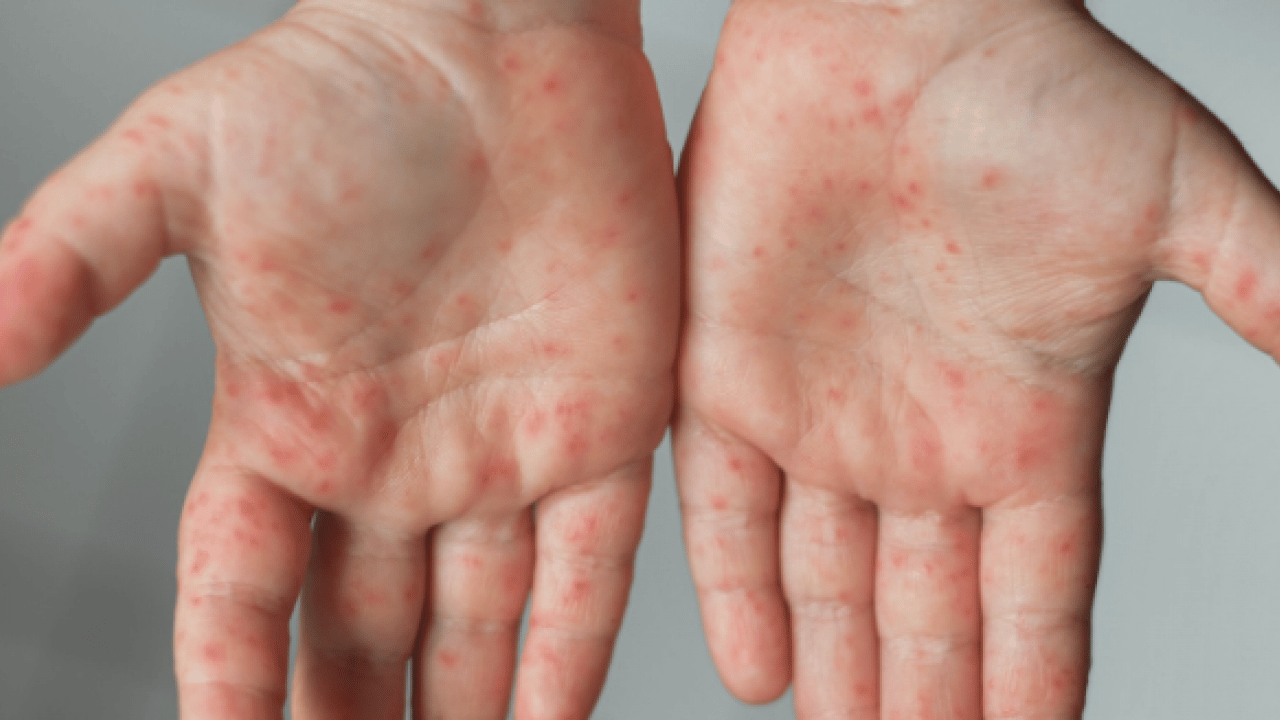 Foto - Bana uğramaz demeyin! Egzama nedir, nasıl oluşur ve nasıl geçer? Tek tek bunları not almalısınız...