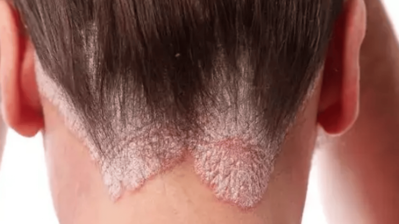 Foto - Bana uğramaz demeyin! Egzama nedir, nasıl oluşur ve nasıl geçer? Tek tek bunları not almalısınız...