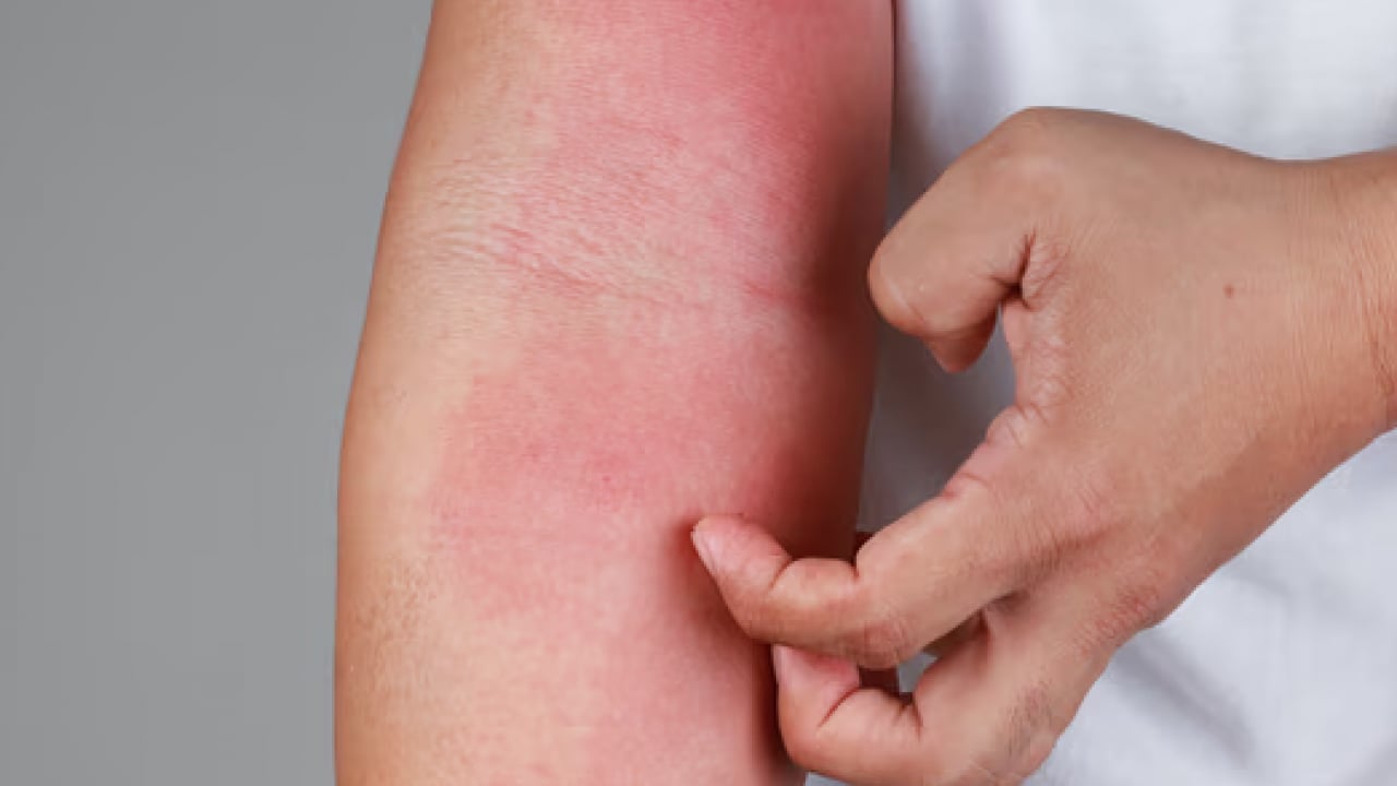 Foto - Bana uğramaz demeyin! Egzama nedir, nasıl oluşur ve nasıl geçer? Tek tek bunları not almalısınız...