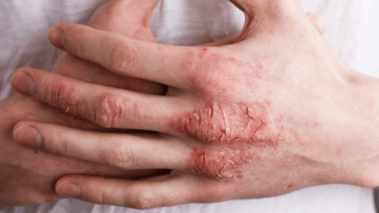 Foto - Bana uğramaz demeyin! Egzama nedir, nasıl oluşur ve nasıl geçer? Tek tek bunları not almalısınız...