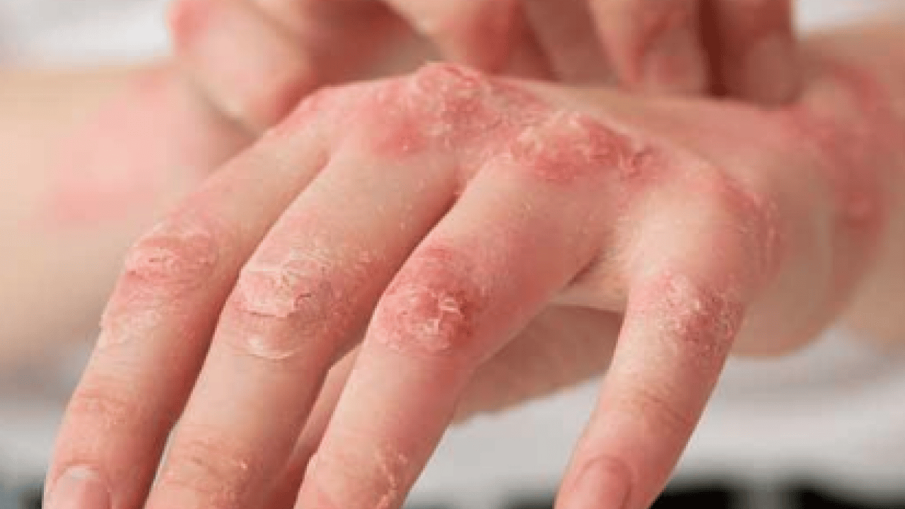 Foto - Bana uğramaz demeyin! Egzama nedir, nasıl oluşur ve nasıl geçer? Tek tek bunları not almalısınız...