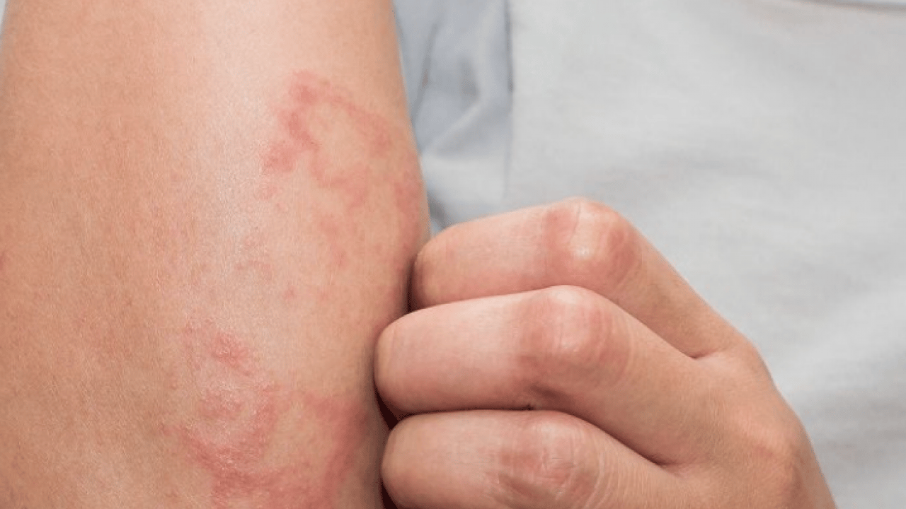 Foto - Bana uğramaz demeyin! Egzama nedir, nasıl oluşur ve nasıl geçer? Tek tek bunları not almalısınız...