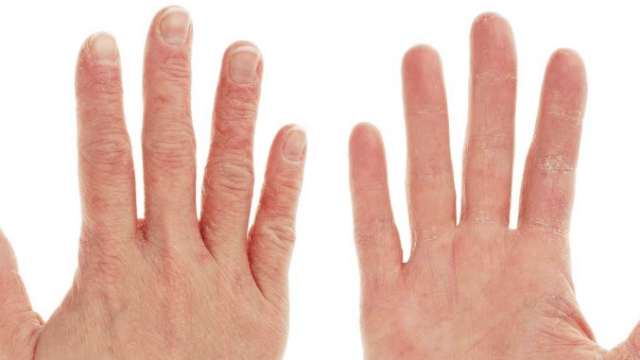 Bana uğramaz demeyin! Egzama nedir, nasıl oluşur ve nasıl geçer? Tek tek bunları not almalısınız...