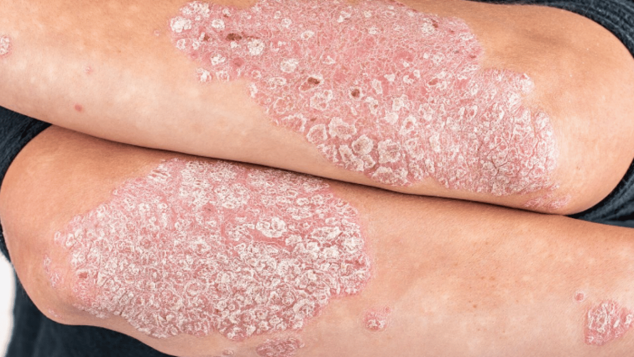 Foto - Bana uğramaz demeyin! Egzama nedir, nasıl oluşur ve nasıl geçer? Tek tek bunları not almalısınız...