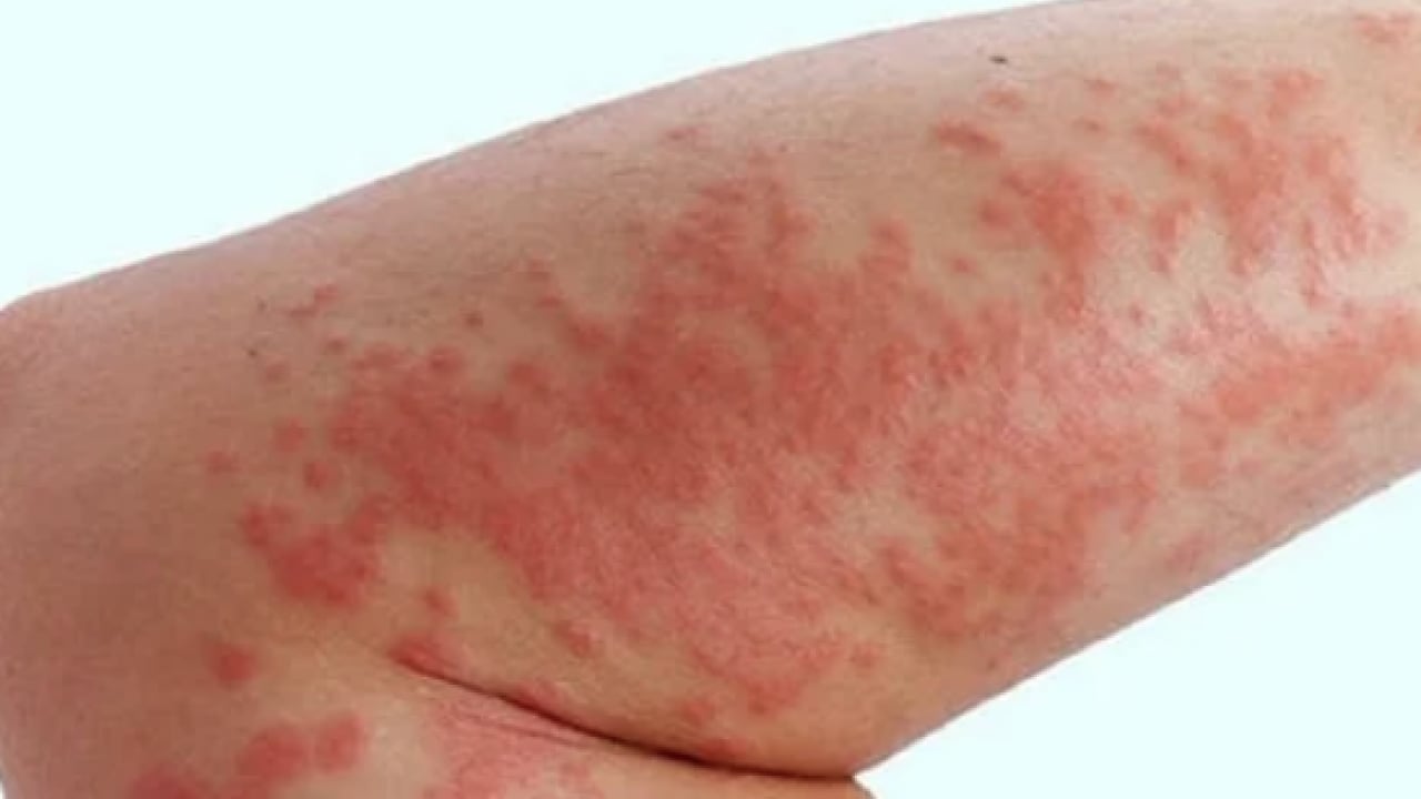 Foto - Bana uğramaz demeyin! Egzama nedir, nasıl oluşur ve nasıl geçer? Tek tek bunları not almalısınız...