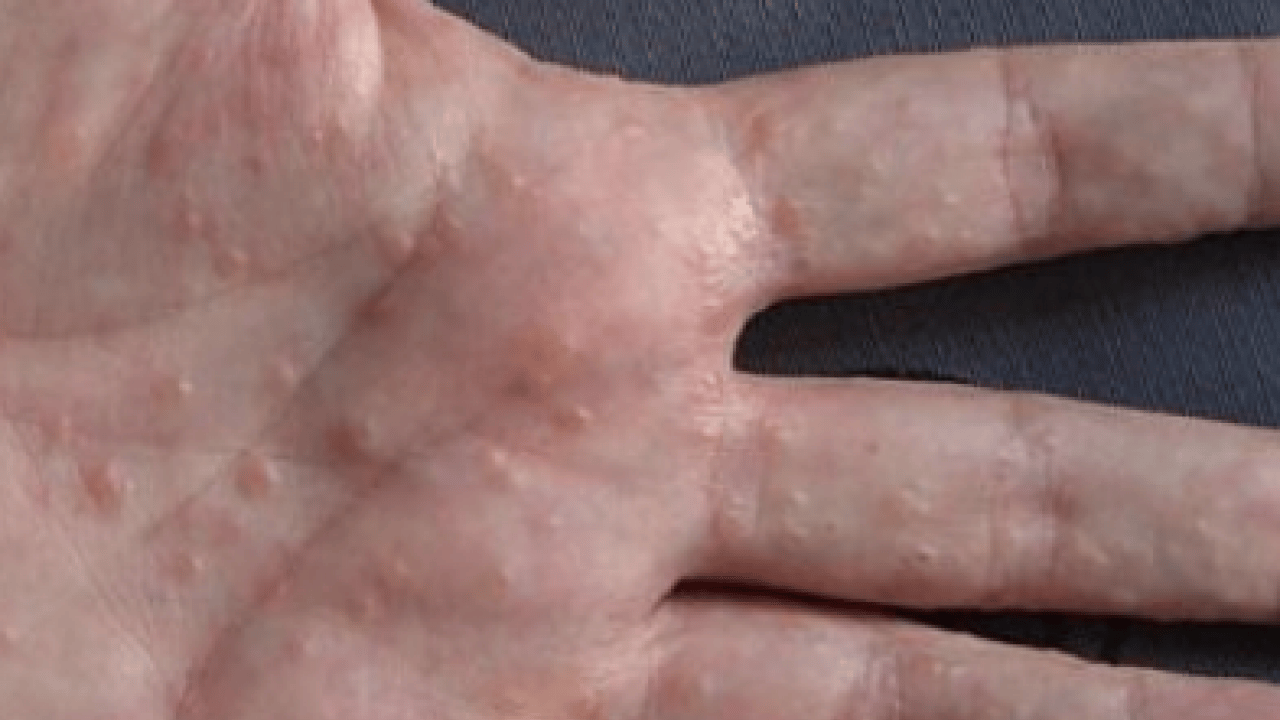 Foto - Bana uğramaz demeyin! Egzama nedir, nasıl oluşur ve nasıl geçer? Tek tek bunları not almalısınız...