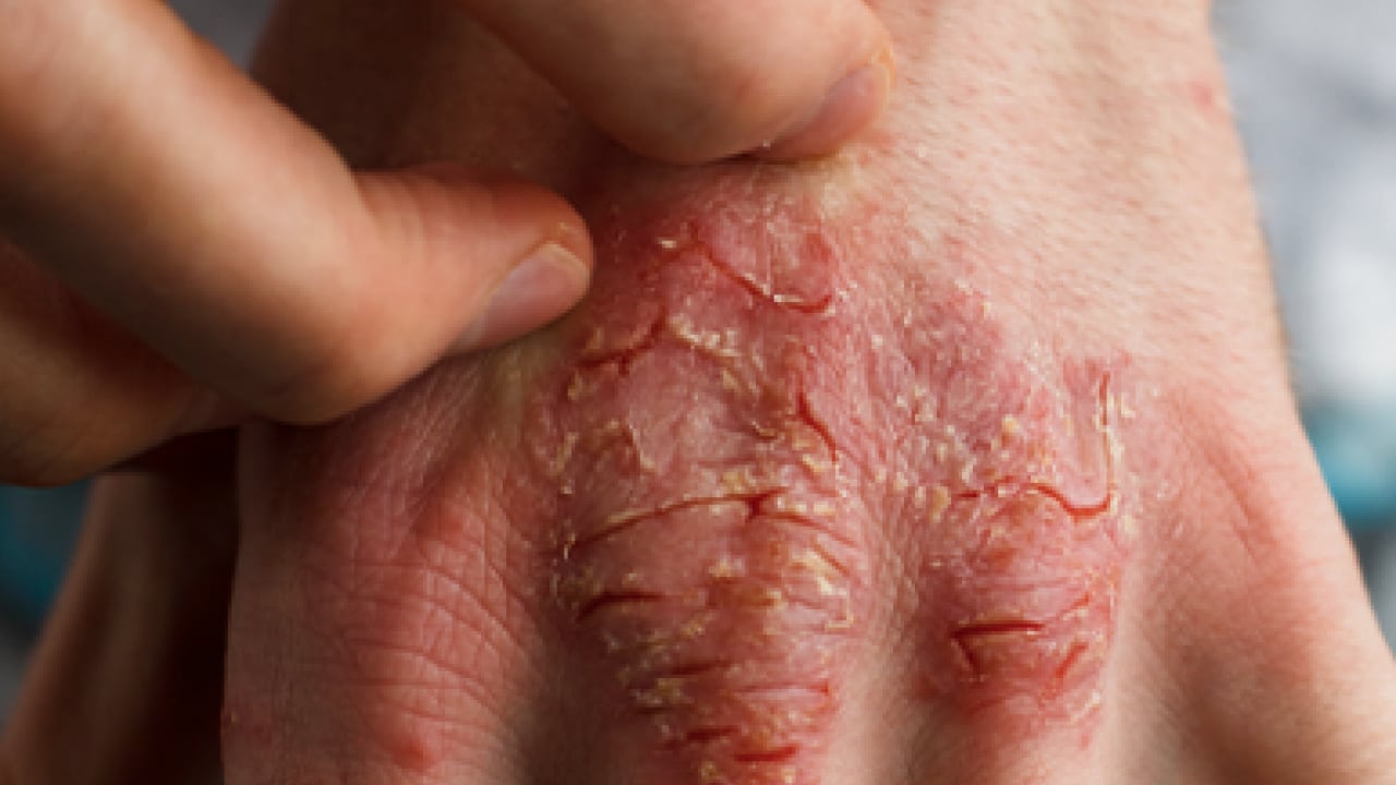 Foto - Bana uğramaz demeyin! Egzama nedir, nasıl oluşur ve nasıl geçer? Tek tek bunları not almalısınız...