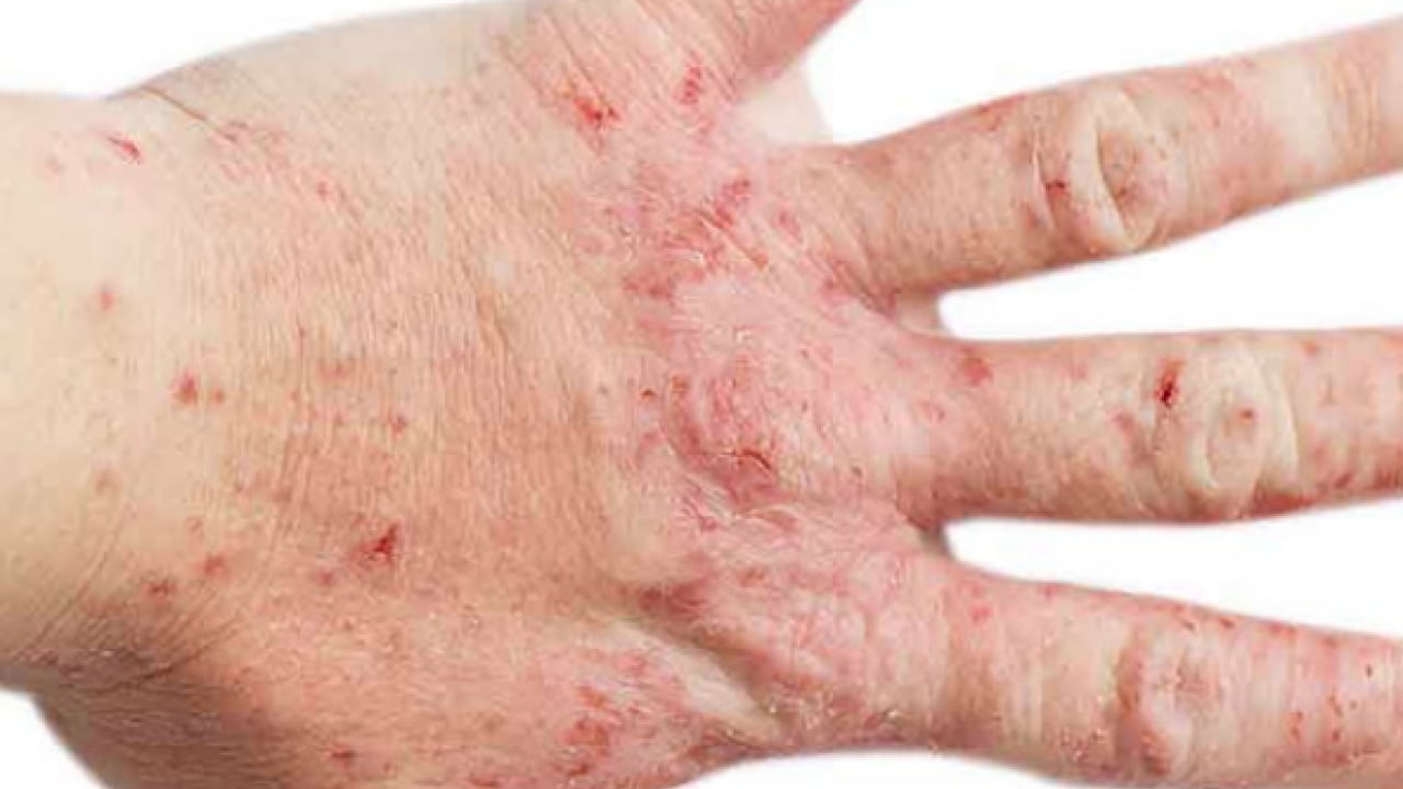 Foto - Bana uğramaz demeyin! Egzama nedir, nasıl oluşur ve nasıl geçer? Tek tek bunları not almalısınız...