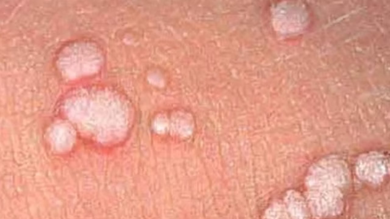 Foto - Baş-boyun kanserlerinde en büyük tehlike korkuttu! Doktor yanıt verdi: 100'den fazla HPV virüsü var