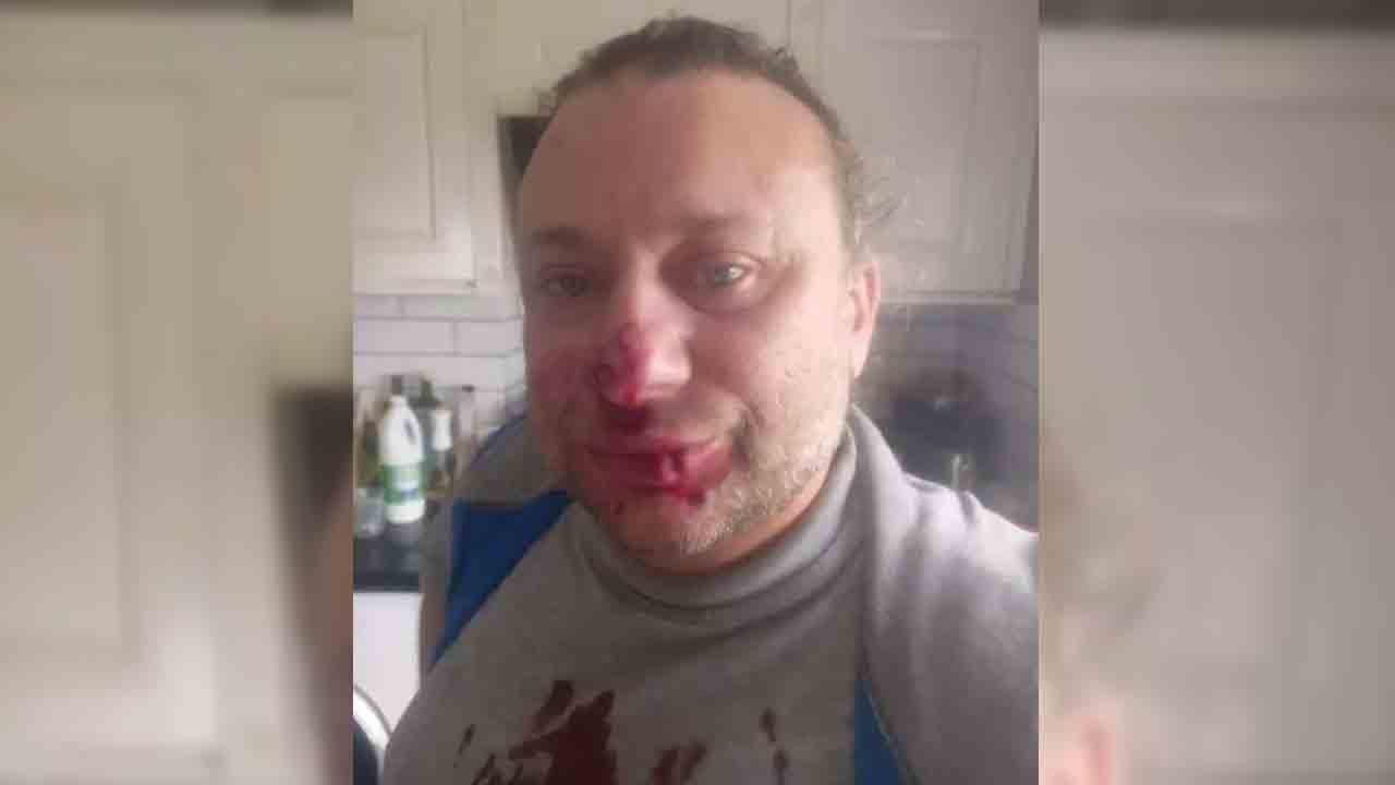 Foto - Başıboş köpeğin saldırdığı şarkıcıdan kötü haber: Entübe edildi, durumu kritik