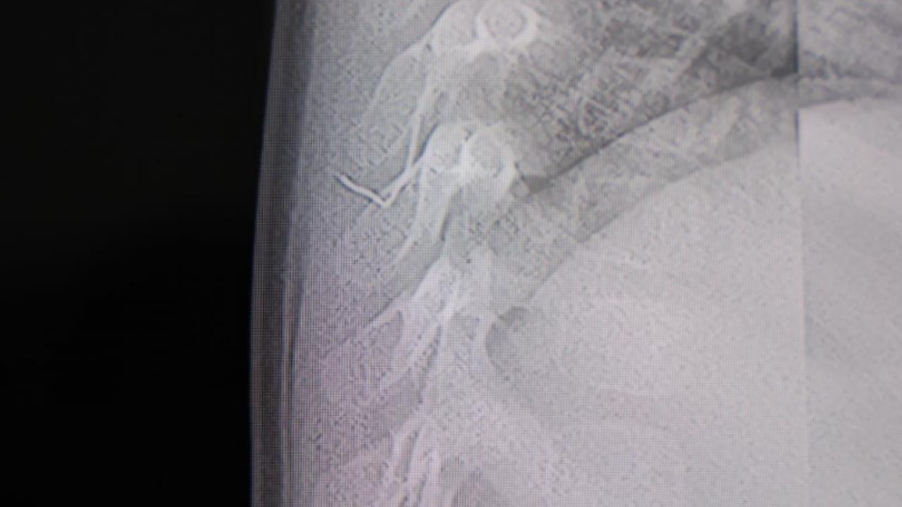 Foto - Bebeğin sırtından çıkan şey şoke etti