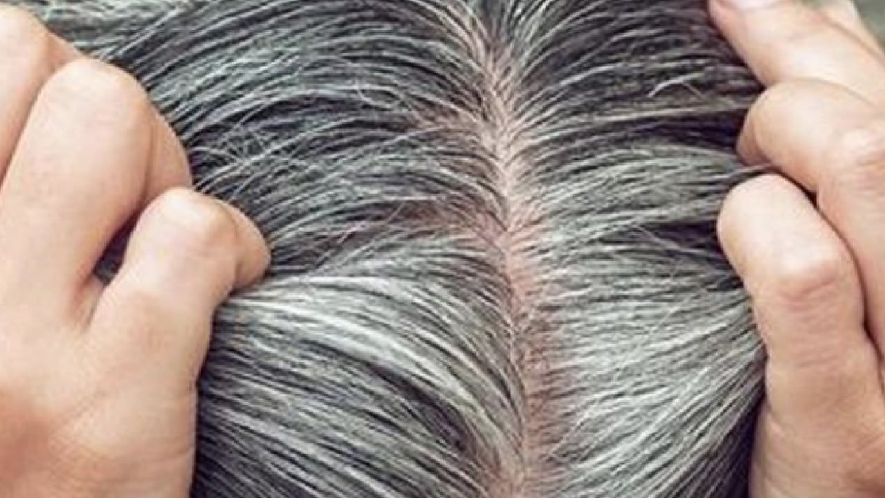 Foto - Belli oldu! Gençlerin saçı neden beyazlar? Ya siz de bu sorunu yaşıyorsanız... 