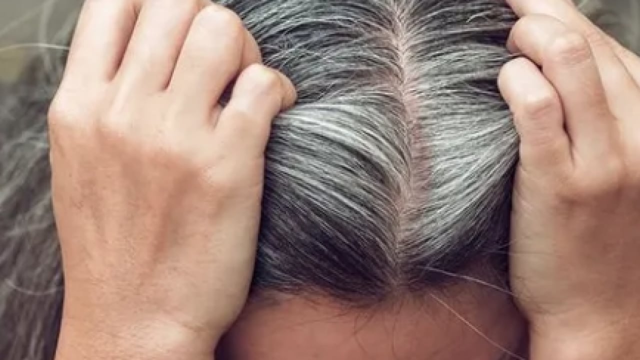 Foto - Belli oldu! Gençlerin saçı neden beyazlar? Ya siz de bu sorunu yaşıyorsanız... 