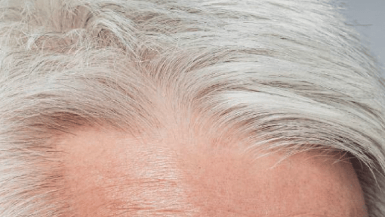 Foto - Belli oldu! Gençlerin saçı neden beyazlar? Ya siz de bu sorunu yaşıyorsanız... 