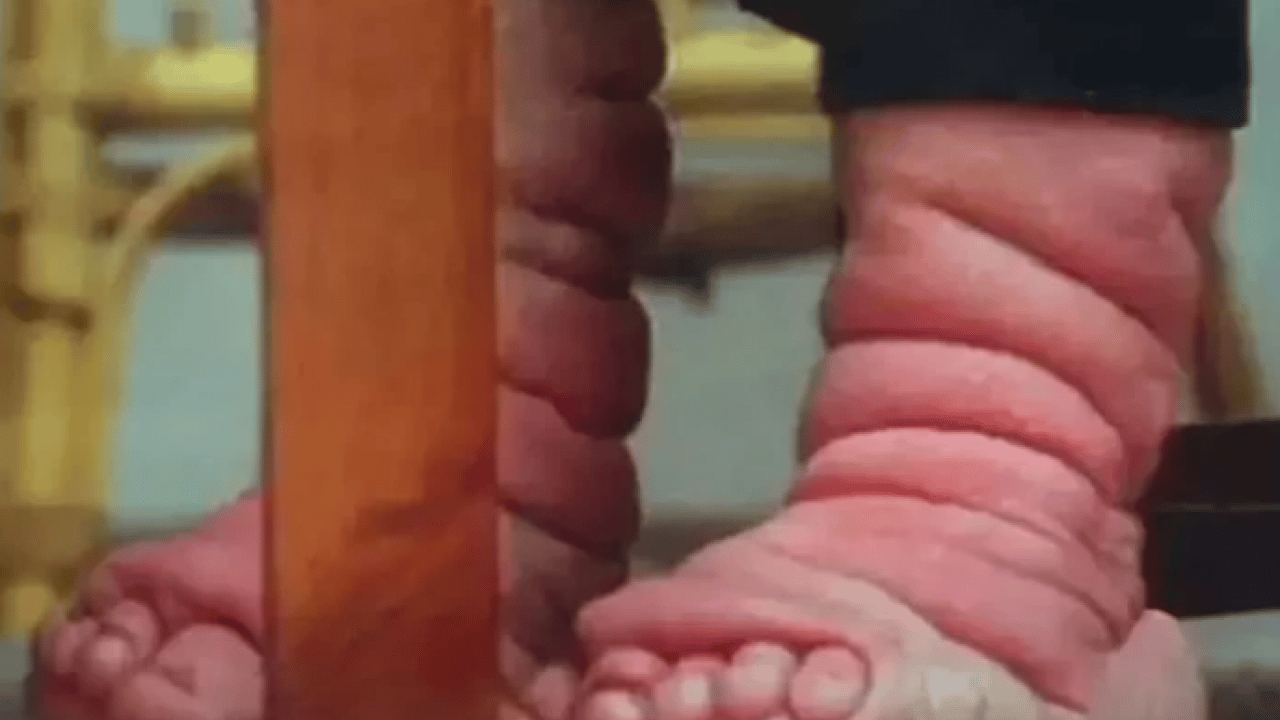 Foto - Benjamin Button filmi gerçek oldu: Yaşlı doğan adamın son hali şaşırttı!