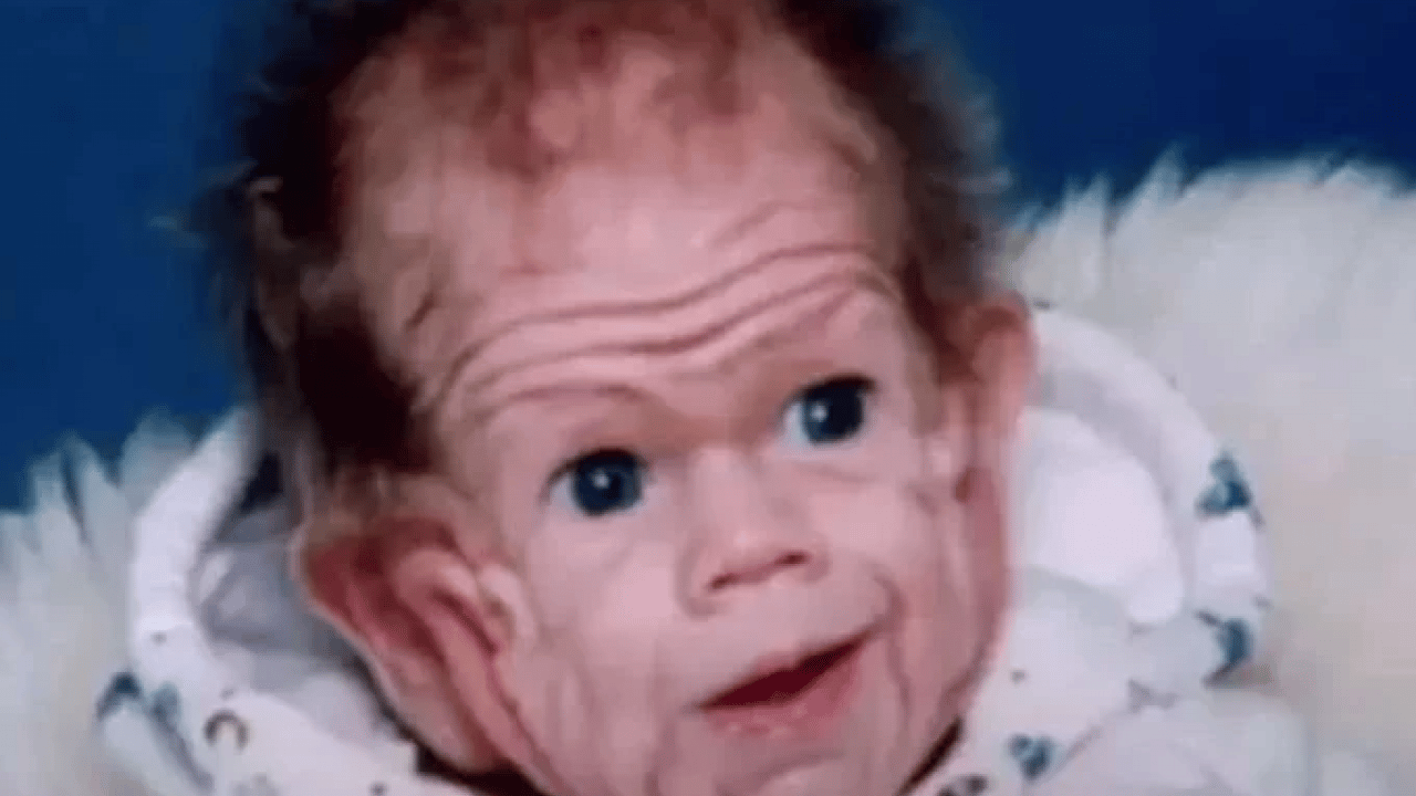 Foto - Benjamin Button filmi gerçek oldu: Yaşlı doğan adamın son hali şaşırttı!