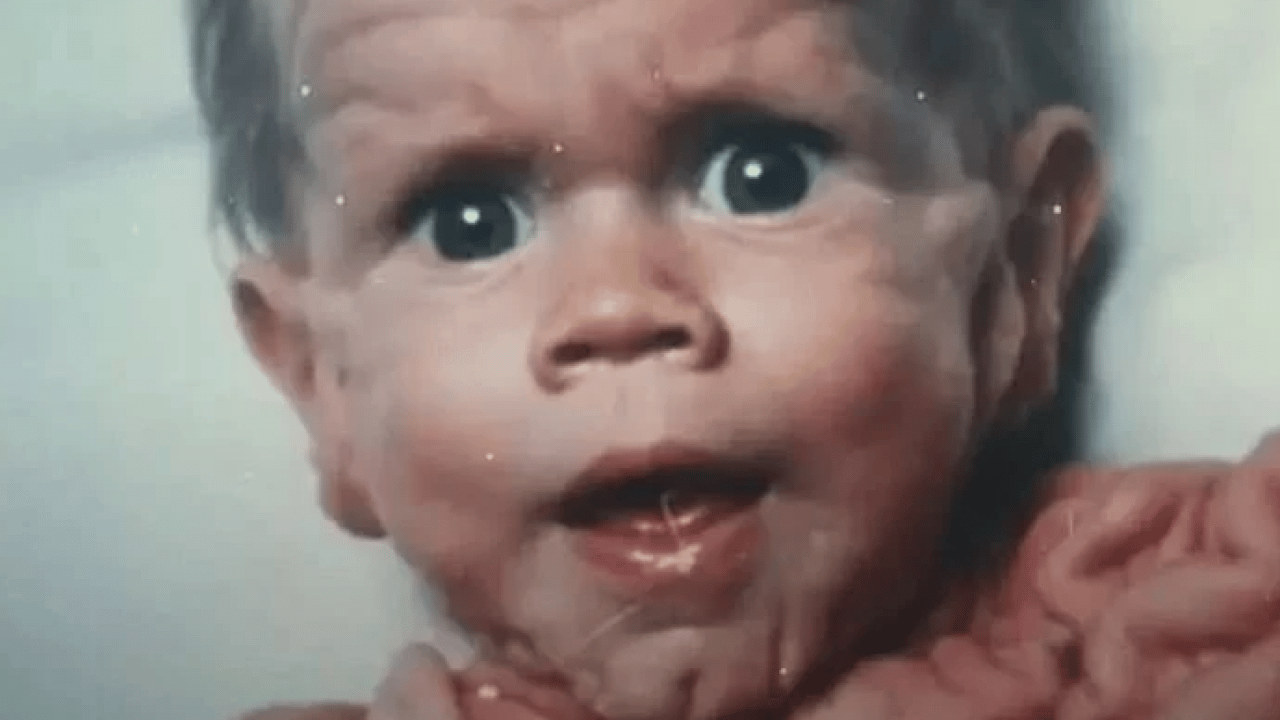 Foto - Benjamin Button filmi gerçek oldu: Yaşlı doğan adamın son hali şaşırttı!