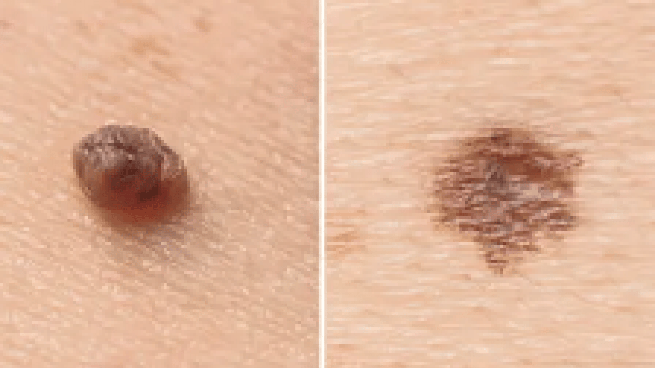 Foto - Benlerin renk değişimi cilt kanseri belirtisi mi, Güneş kremi D vitaminini engeller mi?