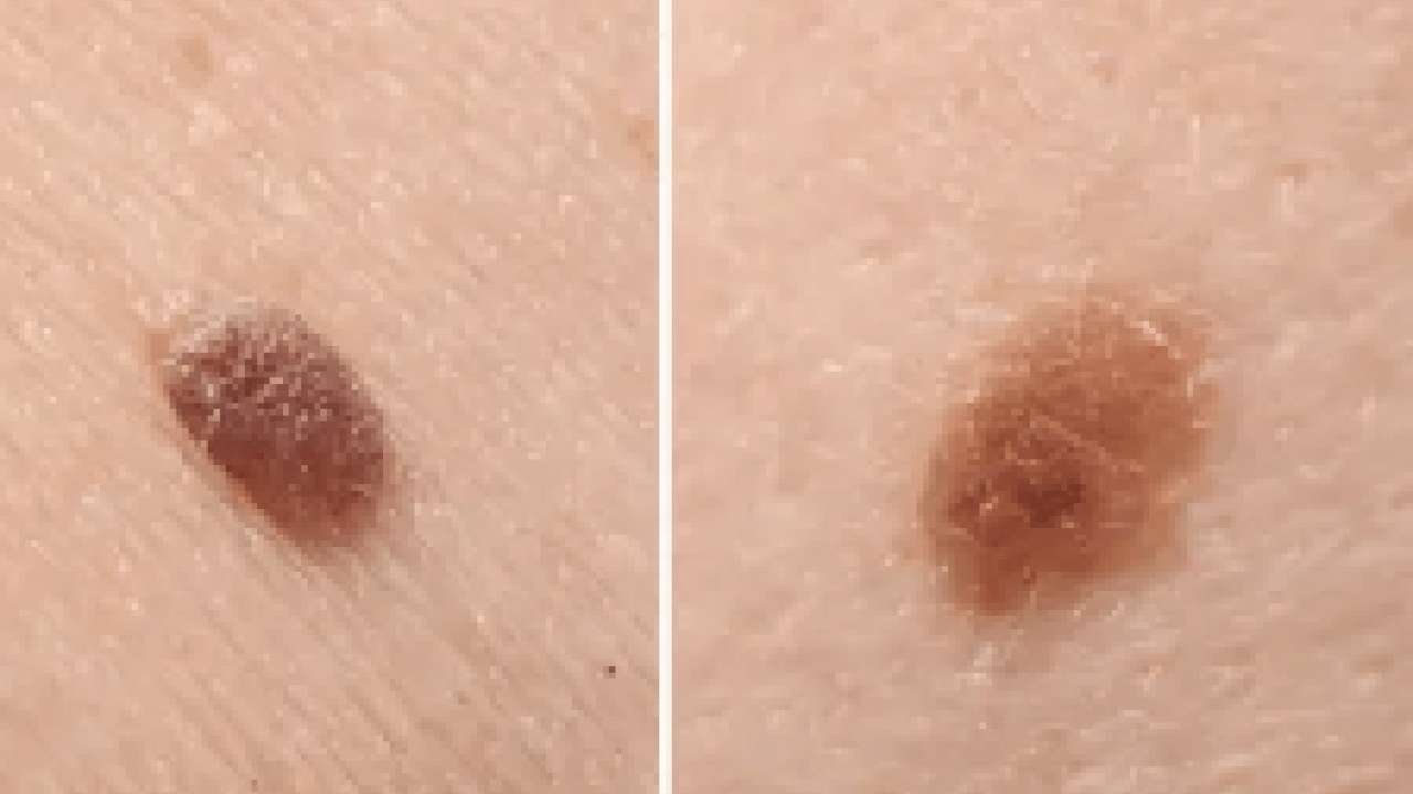 Foto - Benlerin renk değişimi cilt kanseri belirtisi mi, Güneş kremi D vitaminini engeller mi?