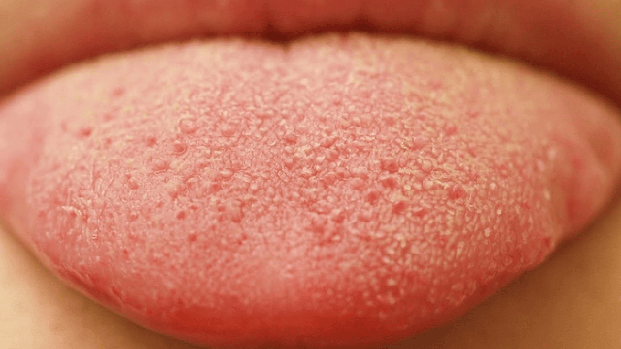 Foto - Beyaz bir dilin mi var? Bu hangi hastalıklara işaret ediyor? Bu rahatsızlık muazzam bir risk, uzmanı işaret etti!