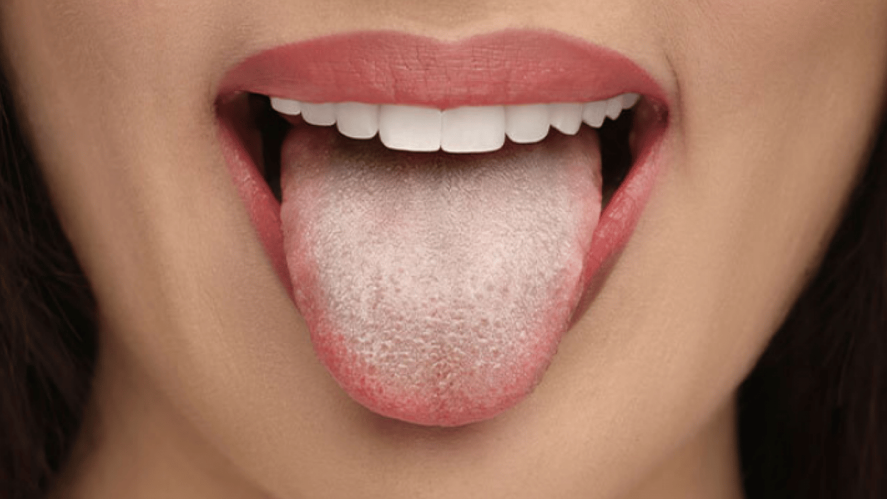 Beyaz bir dilin mi var? Bu hangi hastalıklara işaret ediyor? Bu rahatsızlık muazzam bir risk, uzmanı işaret etti!