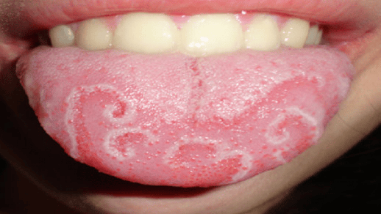 Foto - Beyaz bir dilin mi var? Bu hangi hastalıklara işaret ediyor? Bu rahatsızlık muazzam bir risk, uzmanı işaret etti!