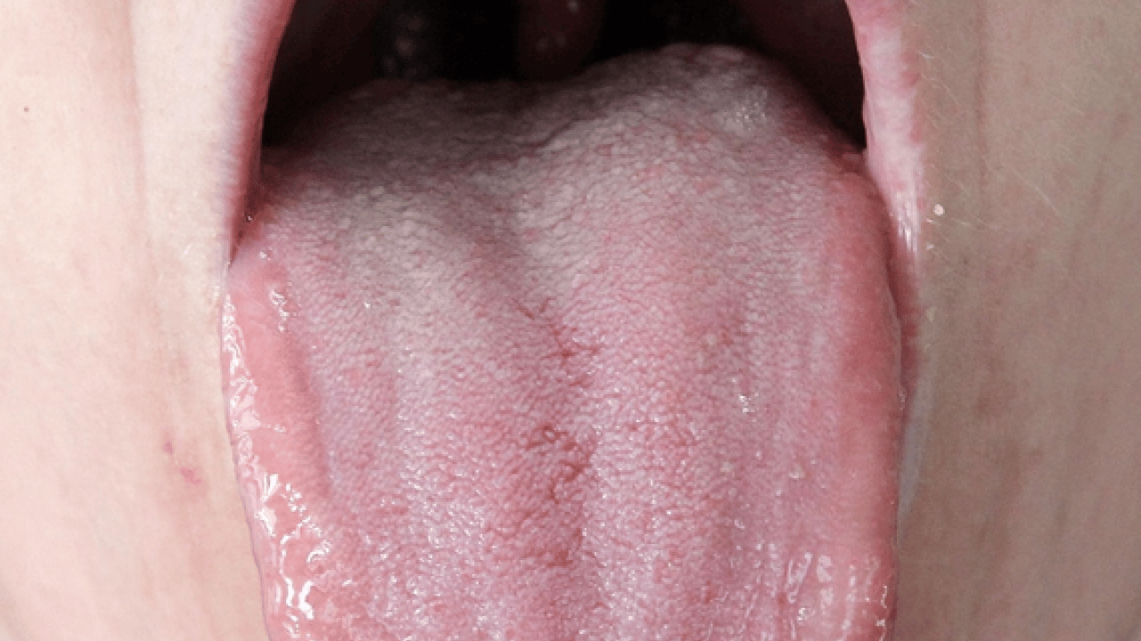 Foto - Beyaz bir dilin mi var? Bu hangi hastalıklara işaret ediyor? Bu rahatsızlık muazzam bir risk, uzmanı işaret etti!